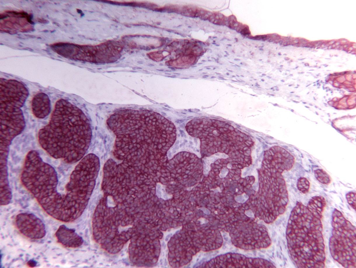 Infiltrative basal cell carcinoma from female Ptch +/- mouse after irradiation with 4 Gy of X-rays.Immunohistochemistry for keratin 14.