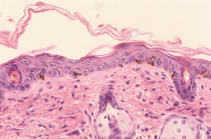 Adrenocortical_Dysplasia_(acd)_Chr8