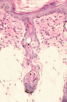 Adrenocortical_Dysplasia_(acd)_Chr8