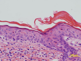 Chronic_Proliferative_Dermatitis_Mutation_(cpdm)_Chr15
