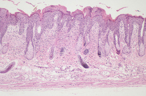 Chronic_Proliferative_Dermatitis_Mutation_(cpdm)_Chr15