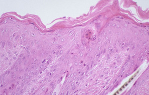 Chronic_Proliferative_Dermatitis_Mutation_(cpdm)_Chr15