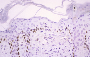 Chronic_Proliferative_Dermatitis_Mutation_(cpdm)_Chr15