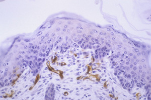 Chronic_Proliferative_Dermatitis_Mutation_(cpdm)_Chr15