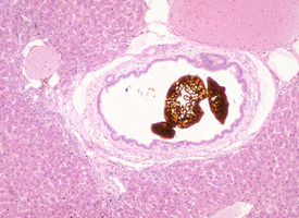 Ferrochelatase_Deficiency(Fech)_Chr18