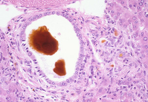 Ferrochelatase_Deficiency(Fech)_Chr18