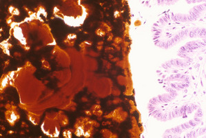 Ferrochelatase_Deficiency(Fech)_Chr18