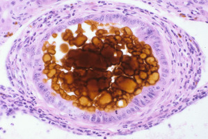 Ferrochelatase_Deficiency(Fech)_Chr18