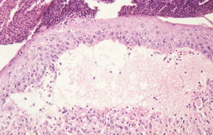 Ferrochelatase_Deficiency(Fech)_Chr18